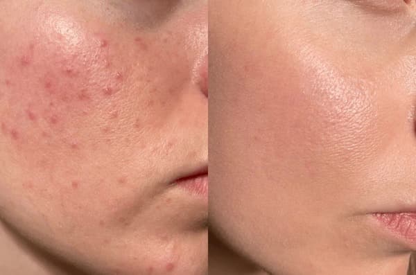 🌸 Tratamientos para acné y manchas